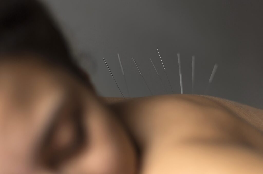 igłoterapia